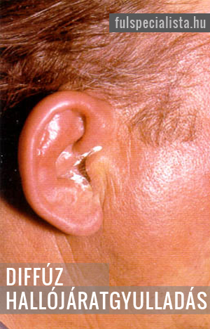 В острой экссудатной фазе диффузного воспаления ушного канала (наружный отит) наружный слуховой канал опухает , в основном заполнен хрупкими клеточными остатками (грамм заражен отрицательными бактериями и анаэробами)